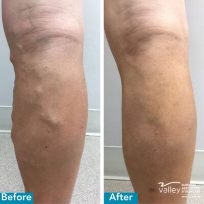 Vein Before and Afters - 2