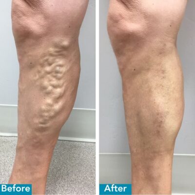 Vein Before and Afters - 3